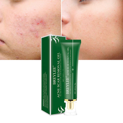US Local Acne Scar Removal Gel Tea Tree Qu Dou Printing