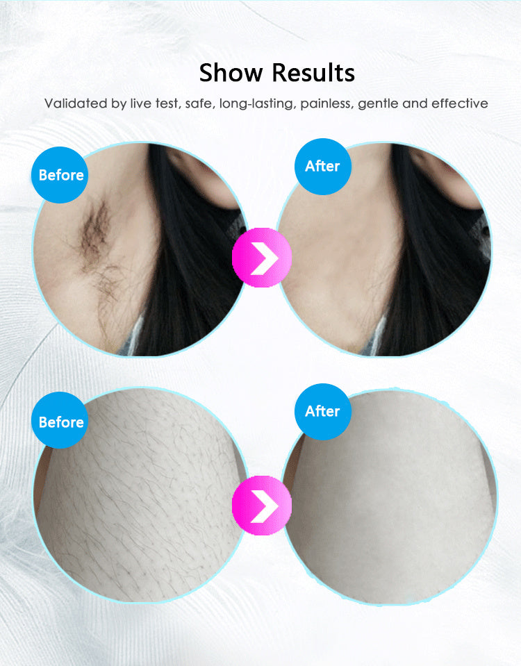 USA Local Laser Hair Removal Equipment