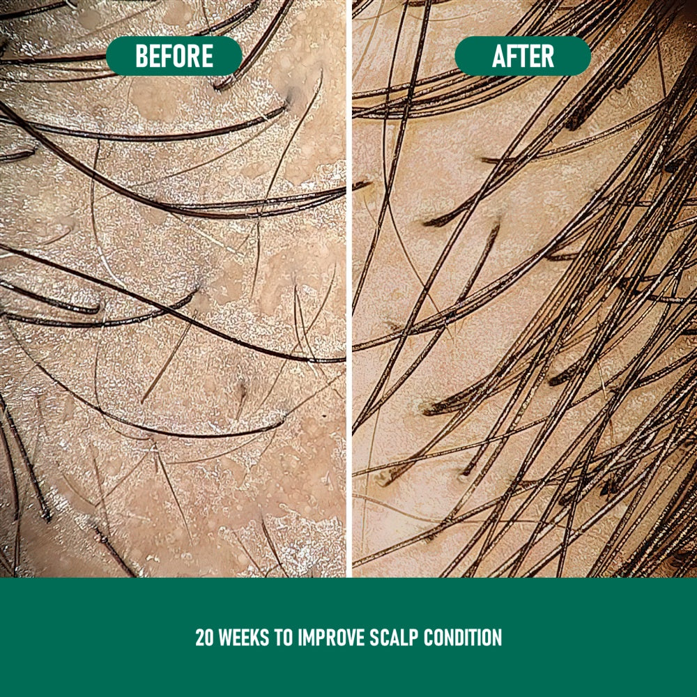 US Local CH004 Minoxidil Anti-Hair Loss Mousse