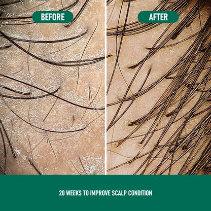 US Local CH004 Minoxidil Anti-Hair Loss Mousse