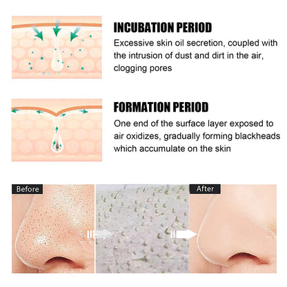 US Local Blackhead Remover Tools -15g Blackhead Creamwith 40Pcs Blackhead Pore Strips