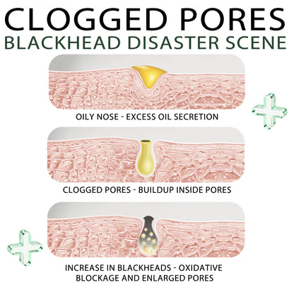 US Local Blackhead Remover Tools -15g Blackhead Creamwith 40Pcs Blackhead Pore Strips